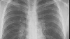 Noile medicamente şi tehnici chirurgicale măresc speranţa de viaţă a bolnavilor de cancer pulmonar