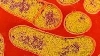 O femeie de 51 de ani din Bistriţa-Năsăud s-a îmbolnăvit de botulism 