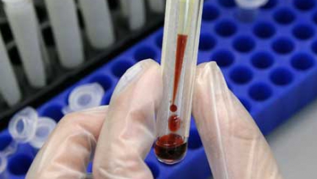 O noua terapie anti-HIV ofera rezultate promitatoare