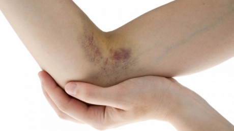 Medicii avertizeaza asupra unei boli autoimune care afecteaza mii de femei tinere si copii