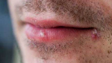 Tot ce trebuie sa stii despre herpes