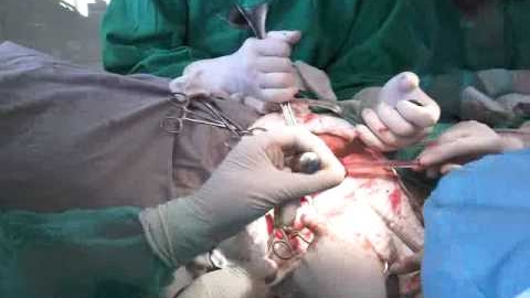 Capacitatea bacteriei poate transforma protezele în culturi infectate