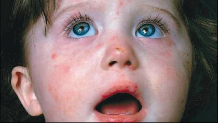 Acestea sunt primele simptome ale RUJEOLEI. Mergi de urgenţă la medic cu copilul tău! 