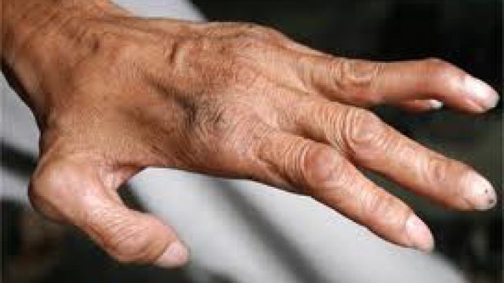 Boala nu a mai fost prezentă în România din anul 1981