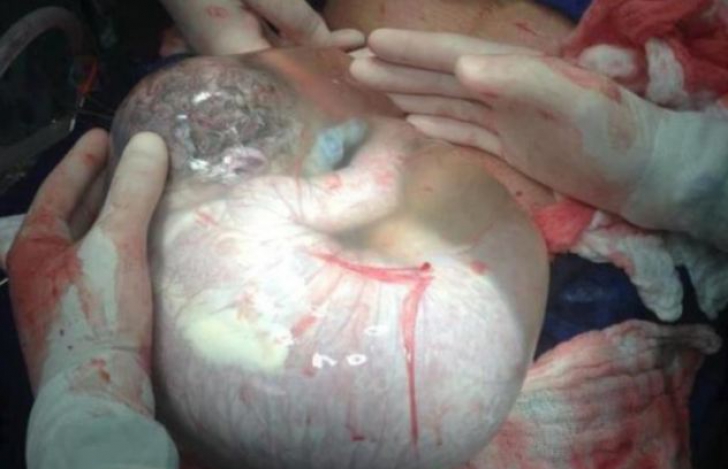 Copil născut într-un sac amniotic intact