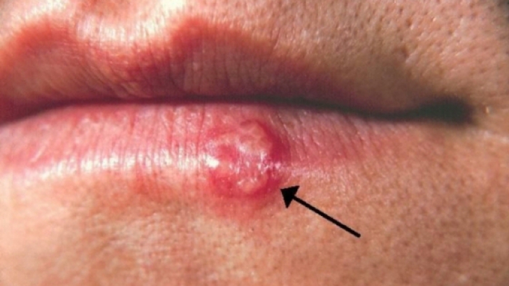 Ce boala grava poate provoca un banal herpes