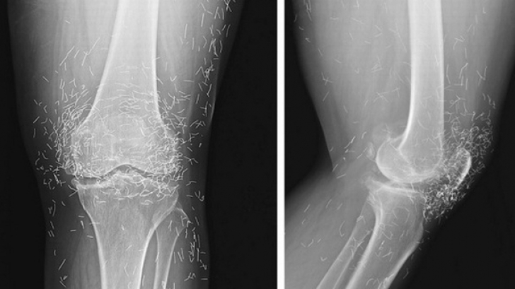 Radiografia unei femei care acuza dureri cumplite la genunchi