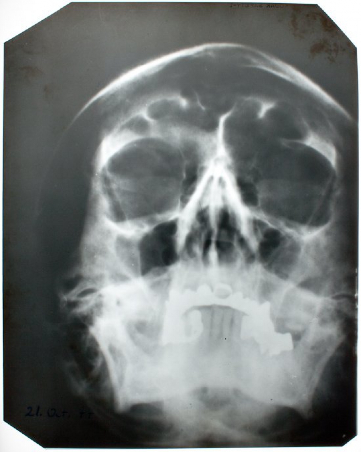 O imagine cu craniul lui Hitler, scoasă la licitație 