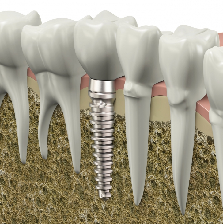 SĂNĂTATE. 5 mituri despre implantul dentar