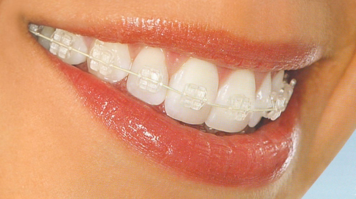 SĂNĂTATE. Aparatul dentar – necesitate sau capriciu?