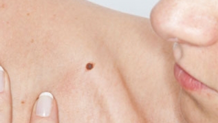 "Multă lume nu ştie că melanomul este o boală mortală", spune medicul Lucian Russu