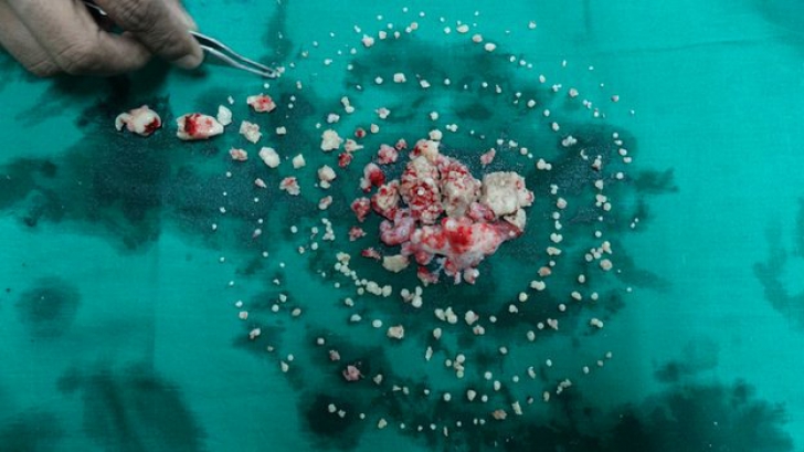 Medici din India au extras 232 de dinți din gura unui adolescent 
