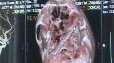 S-a dus la un control banal, cu dureri de cap. Medicii s-au ÎNGROZIT când au văzut ce are în craniu