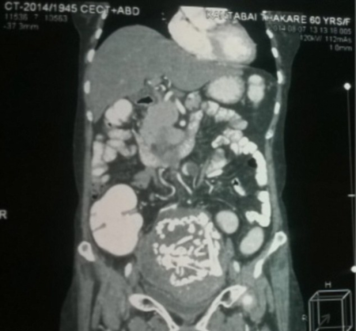 Scheletul unui fetus vechi de 34 de ani, extras din burta unei femei
