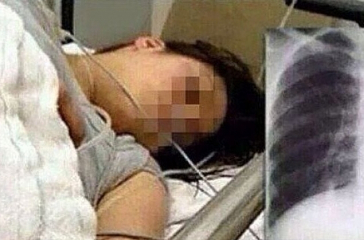 Medicii au văzut radiografia şi au ÎNCREMENIT. Pacienta: "L-am înghiţit de teama prietenului meu"
