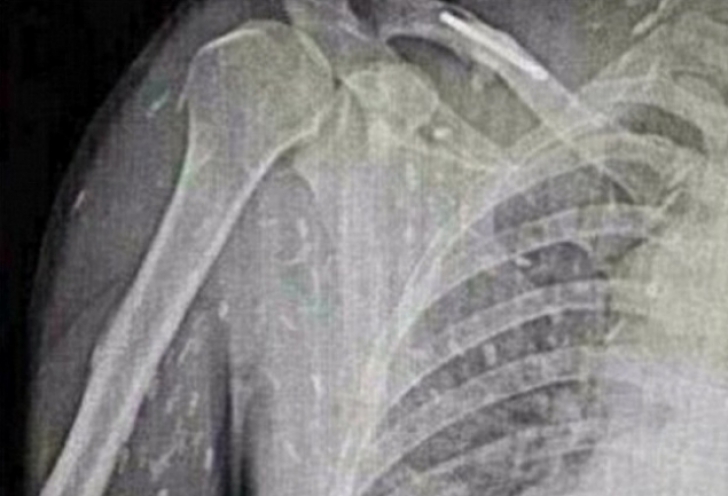 Radiografiile bărbatului din China au îngrozit medicii