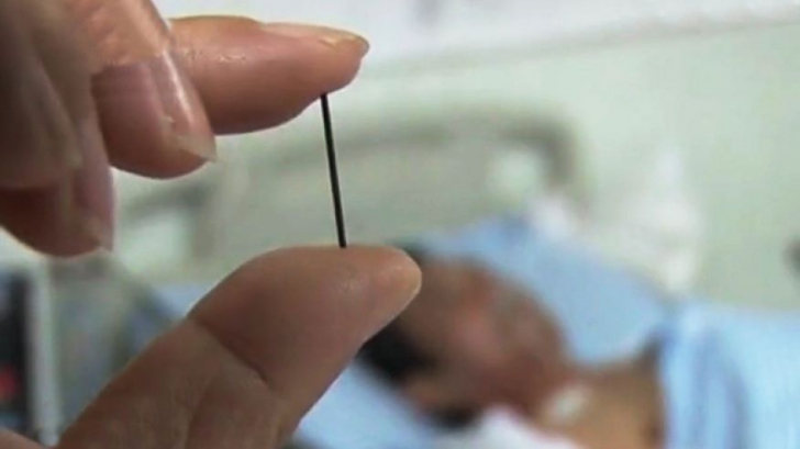 Ce au descoperit medicii, uitat în corpul bărbatului: un ac de acupunctură