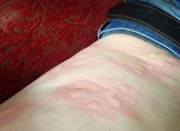 Tânărul a făcut o puternică reacţie alergică, după ce a luat un medicament împotriva răcelii