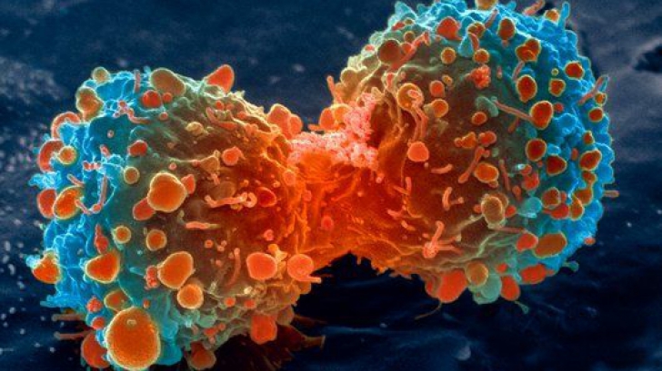 CANCERUL DE ESOFAG ar putea fi diagnosticat rapid cu ajutorul unui BURETE
