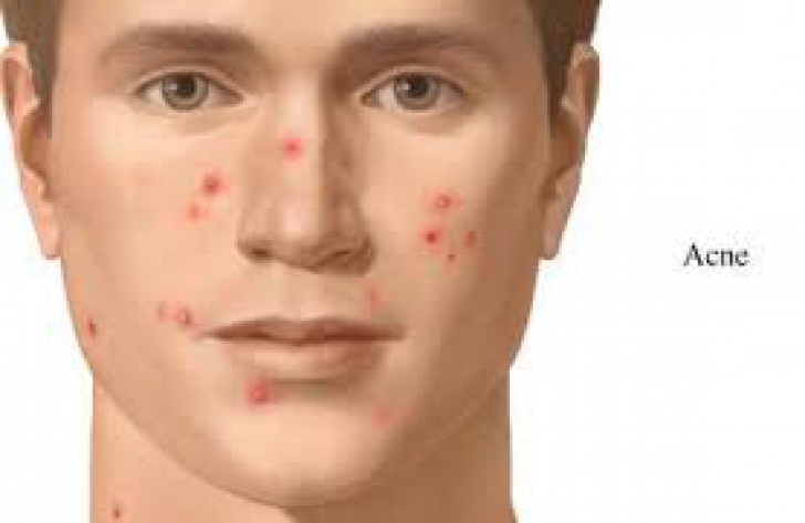 Cum scapi usor de acnee