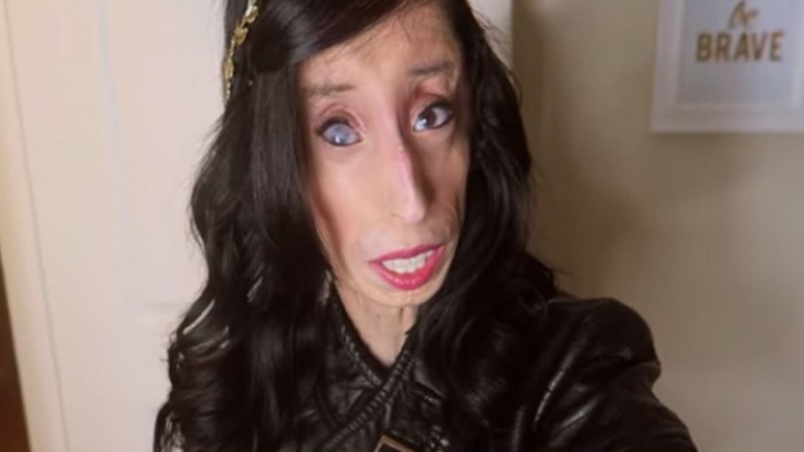 Minunata lecție de viață oferită de tânăra numită „cea mai urâtă femeie din lume”