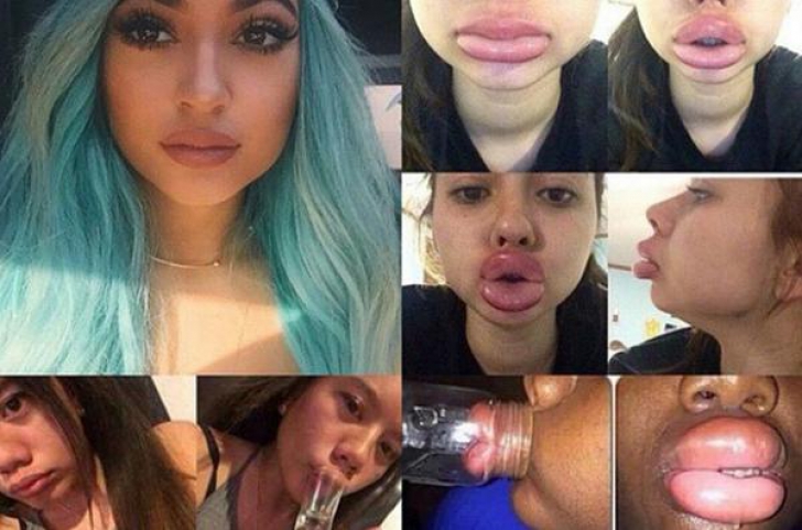 Provocare virală: buze ca ale surorii lui Kim Kardashian. Rezultate: catastrofale, dar amuzante