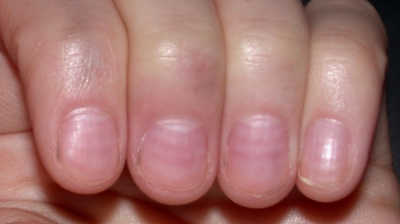 Dungile roşii şi mici care apar sub unghii pot semnala o problemă gravă de sănătate