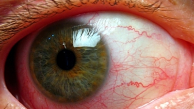 Ochiul roşu poate trăda probleme grave de sănătate. 4 situaţii în care trebuie să te îngrijorezi