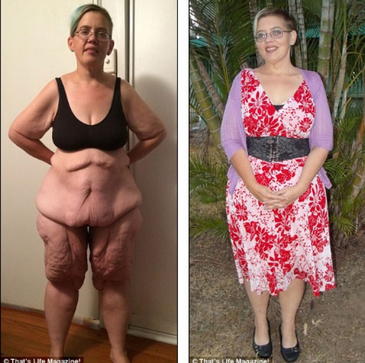 A slăbit 100 de kilograme, însă când se dezbracă e de neimaginat! Cum arată femeia obeză acum