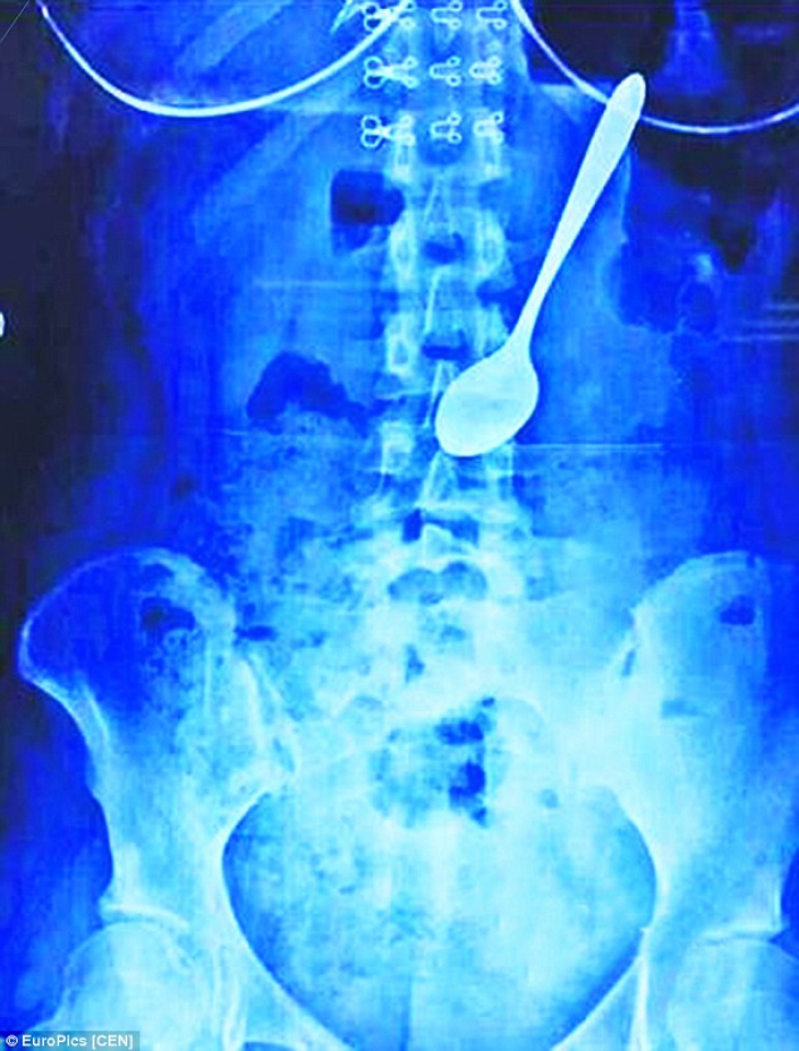 Ce au descoperit medicii în radiografia stomacului unei studente. Totul, din pricina sperieturii!