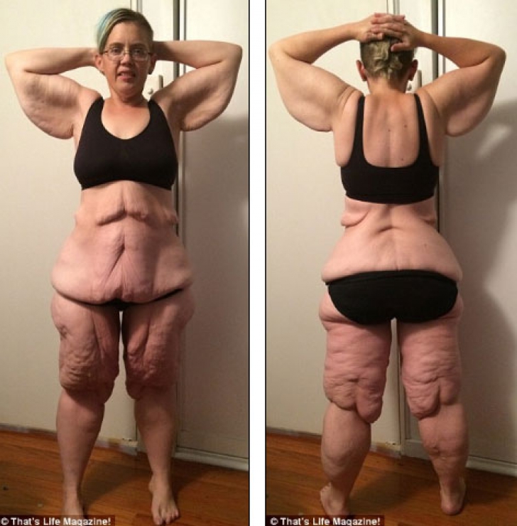 A slăbit 100 de kilograme, însă când se dezbracă e de neimaginat! Cum arată femeia obeză acum