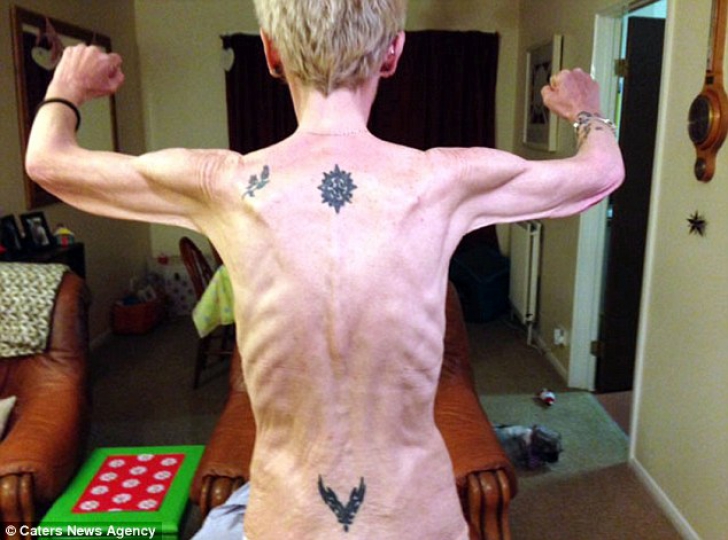 Era obeză şi a ajuns anorexică după ce a slăbit 127 de kilograme! Cum arată acum