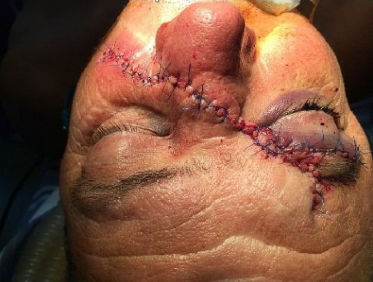 Horror! Cum arată un bărbat român după ce s-a mutilat cu flexul. Medicii l-au operat cinci ore