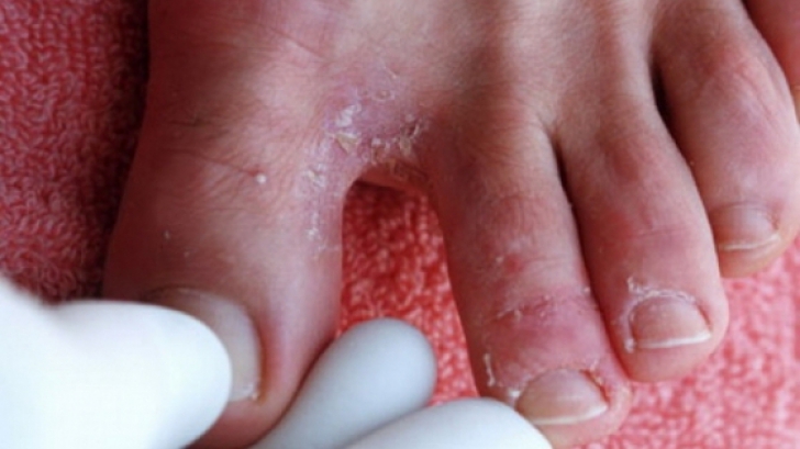 ciupercă pe pielea picioarelor lângă unghie