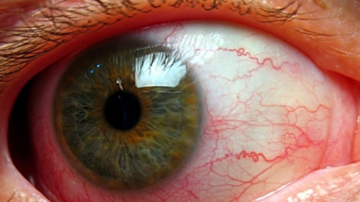 Ochii rosii : Cauze, simptome si tratament