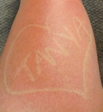 "Tatuajele solare", noul trend care face ravagii pe internet 