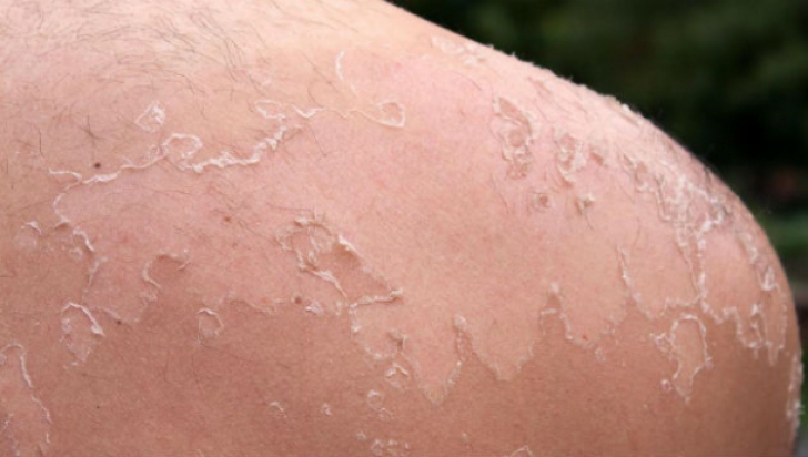 Cum să scapi de cojile de pe piele care se formează după ce te-ai ars la soare