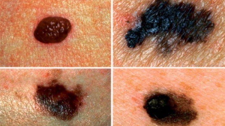 Metoda prin care poţi verifica imediat care aluniţe reprezintă un risc de cancer de piele