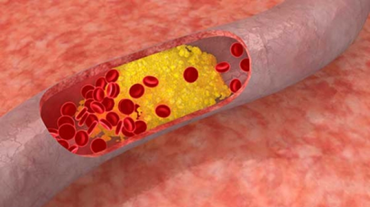 6 lucruri pe care nu le ştiai despre colesterol