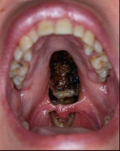 Fotografia şocantă care a creat panică pe Facebook! Cum arată gura unui consumator de cocaină!