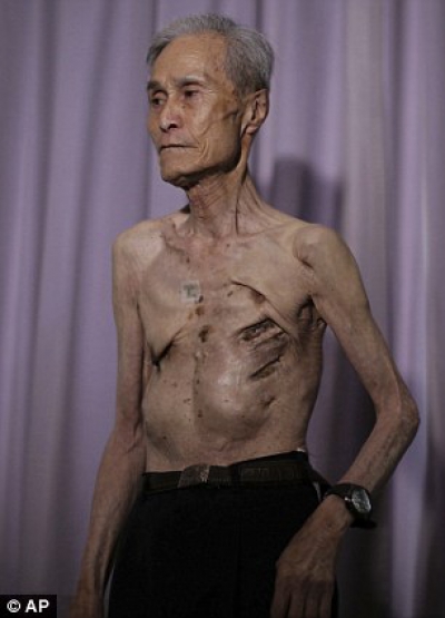 Imagini sfâșietoare. Cicatricile lăsate pe trupul unui bătrân de explozia de la Nagasaki