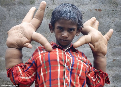 Drama băiatului cu mâini gigantice. I se spune "copilul diavolului"