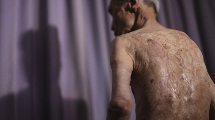 Imagini sfâșietoare. Cicatricile lăsate pe trupul unui bătrân de explozia de la Nagasaki