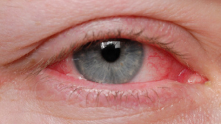 Cinci semne că ar trebui să mergi la un consult oftalmologic