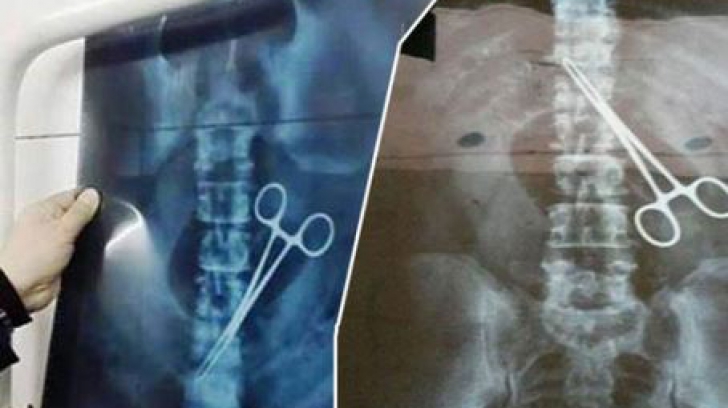 Ce au găsit medicii în stomacul unui bărbat. S-a dat de gol la detectorul de metale din aeroport