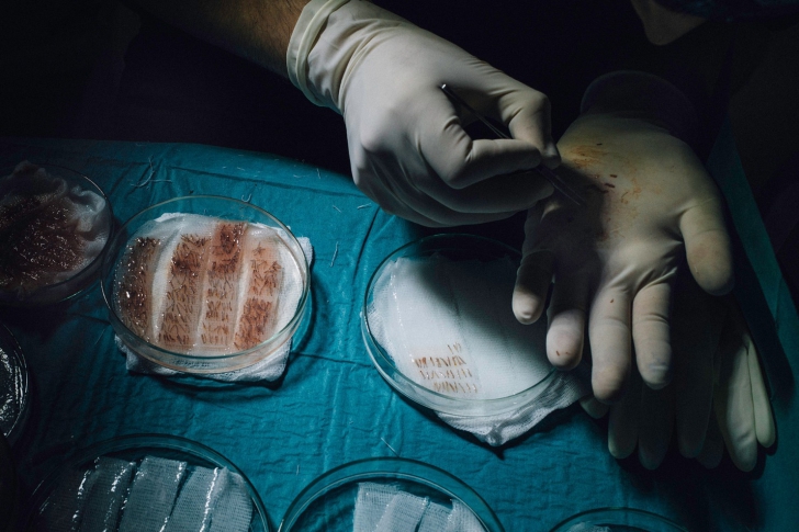 Solutia minune pentru chelie