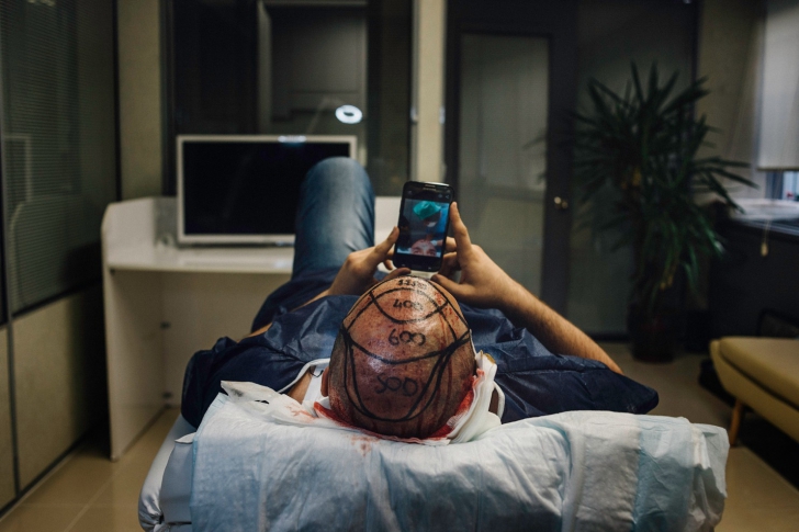 Solutia minune pentru chelie