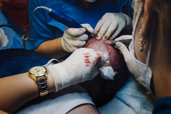 Solutia minune pentru chelie