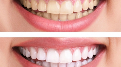 Un ingredient ieftin albeşte dinţii la fel de bine ca tratamentele scumpe. Iată cum să-l foloseşti