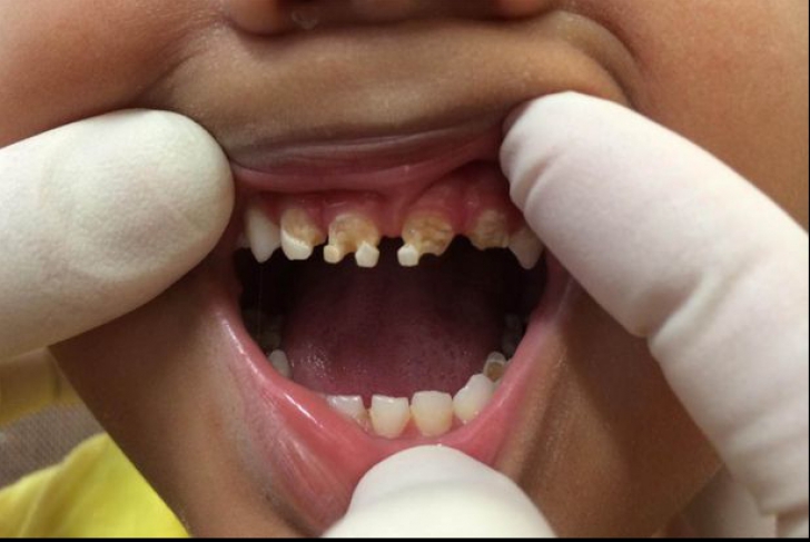 Efectul devastator al băuturilor carbogazoase asupra dinților la copii. Imagini care te vor șoca